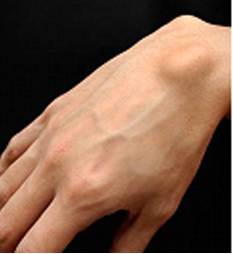 Ganglion Cyst Image