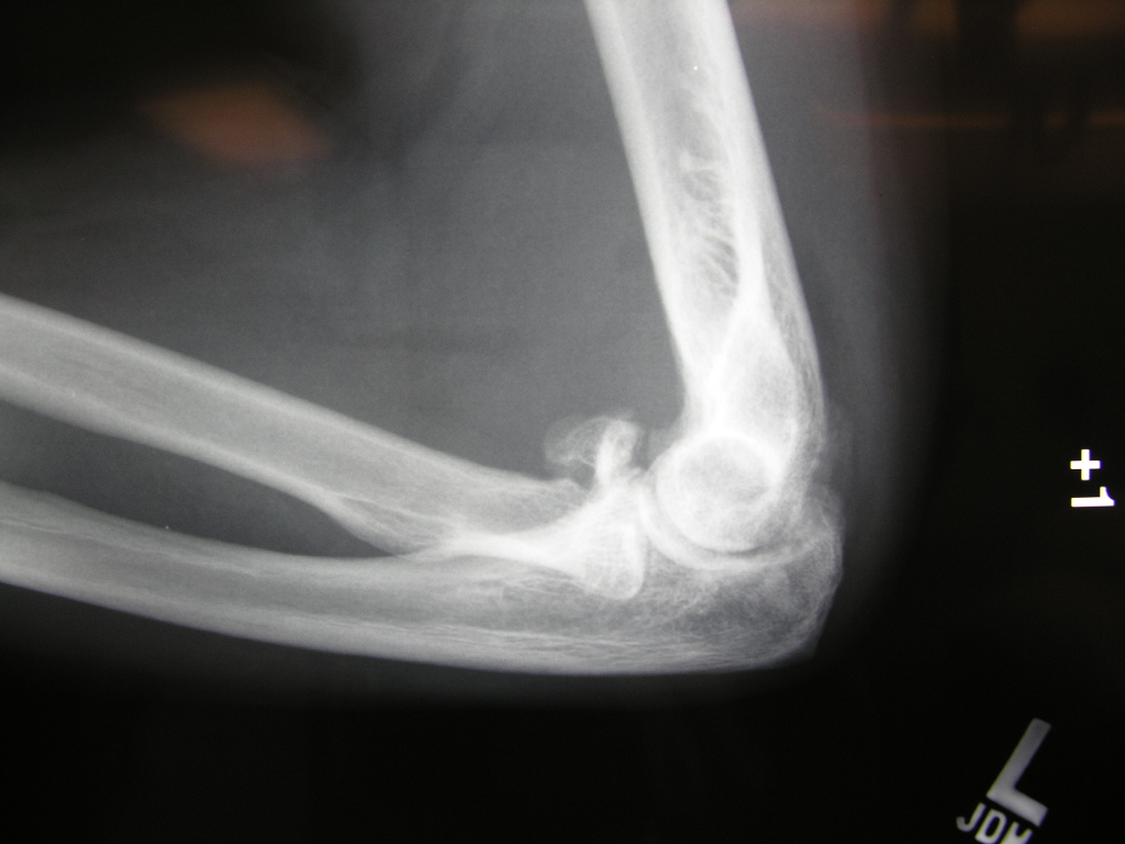 Radial Head Fracture XRay