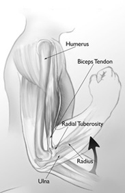 Distal Biceps Clinical Photo