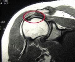 Shoulder MRI